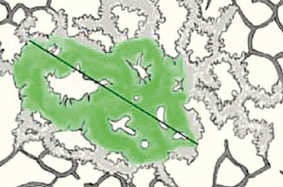 Les nodules sub-solides solitaires