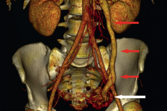 Dilatations veineuses pelviennes (2ème partie)