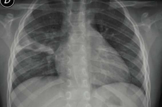 Opacité persistante sur la radiographie thoracique : à quoi penser ?