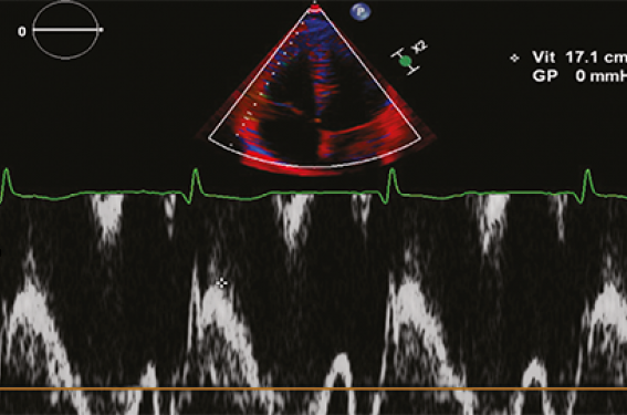Comment évaluer la fonction systolique et diastolique du ventricule droit ?